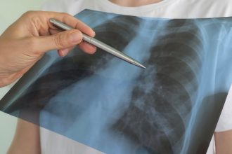 Câncer de pulmão do Papa Leão XIV alerta para número crescente de não fumantes diagnosticados com a doença