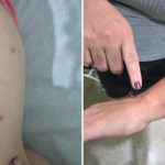 Coceiras, manchas na pele: o que indicam os sintomas apresentados por adultos e crianças em Brodowski, SP
