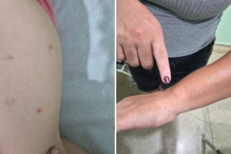 Coceiras, manchas na pele: o que indicam os sintomas apresentados por adultos e crianças em Brodowski, SP