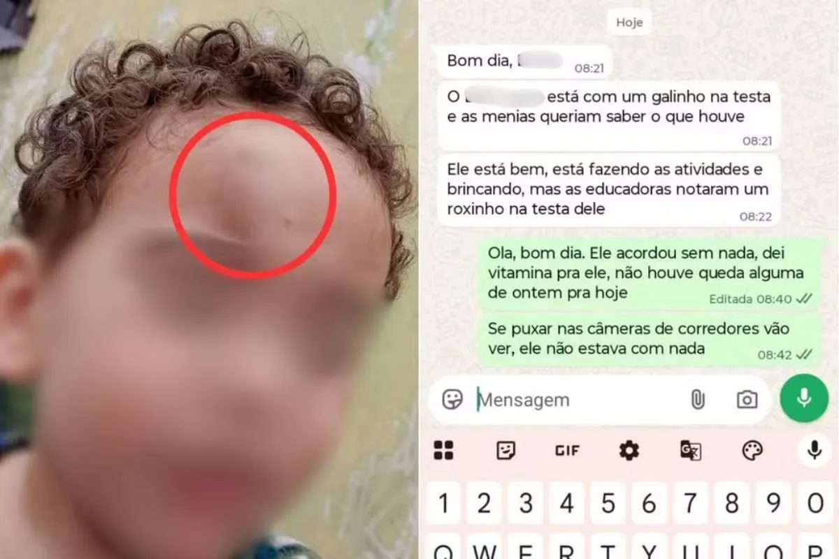 Mãe denuncia creche após menino de 2 anos aparecer com hematoma no rosto no litoral de SP