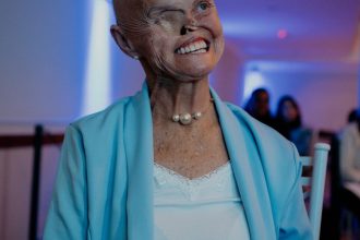 Mulher com síndrome genética rara já teve 73 cânceres de pele e espera cirurgia para reconstruir o nariz